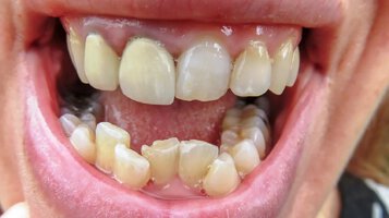 Crooked-bottom-teeth-1296x728-gallery_slide1.jpg